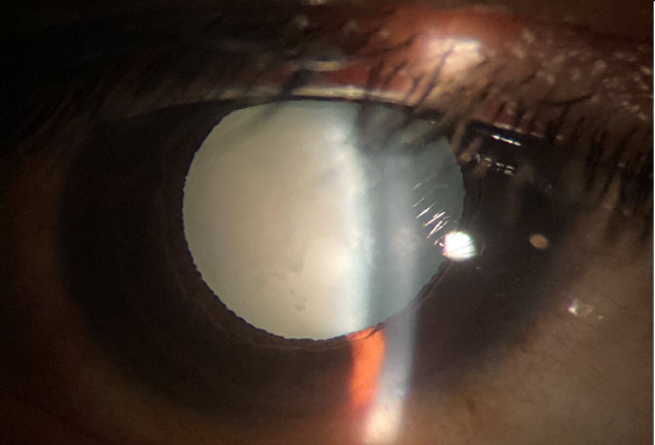 What the Eyes Tell You 15 Abnormalities of the Lens
