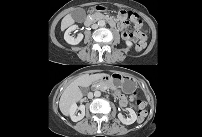 10 Causes Of Abdominal Pain In The Elderly