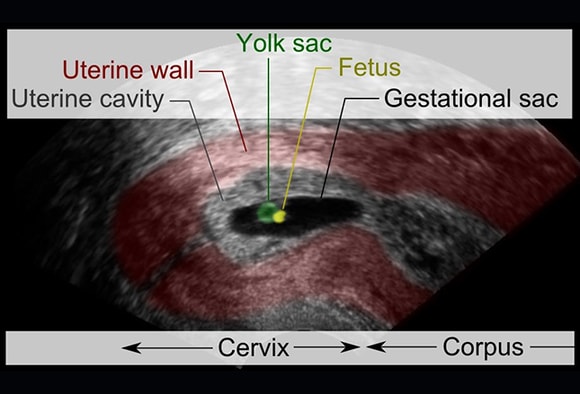 Baby Belly Aches: 15 Causes of Abdominal Pain in Pregnancy Baby Belly Aches: 15 Causes of Abdominal Pain in Pregnancy