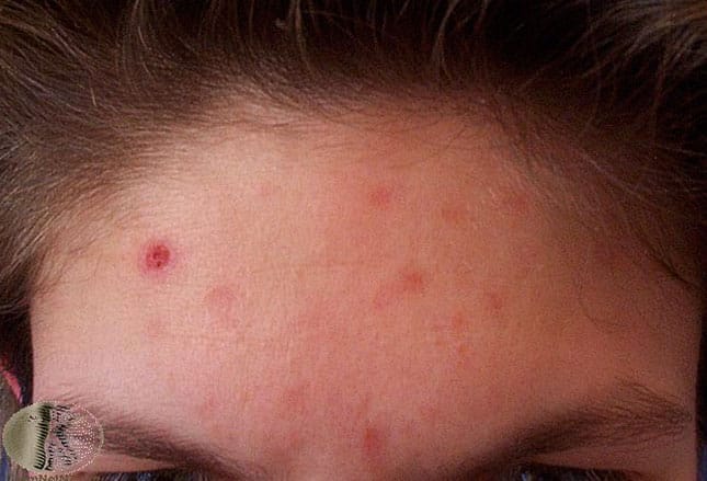 Acne Infested Acne: More Than Skin Deep