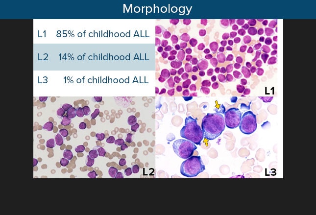 presentation of a child with acute lymphoblastic leukemia