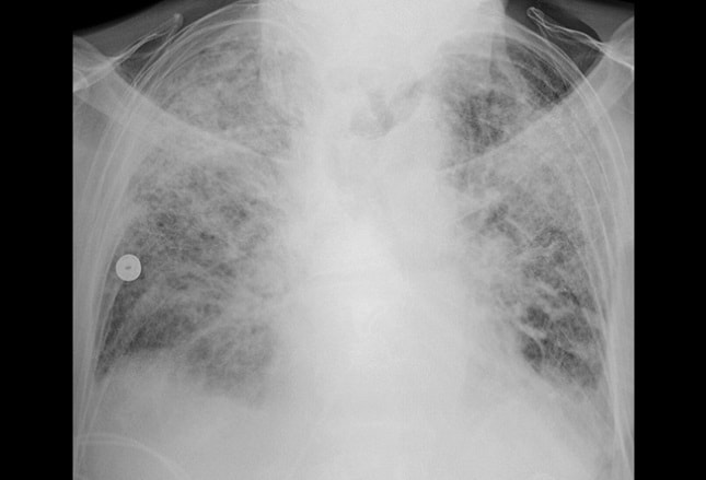 Acute Respiratory Distress Syndrome: A Complex Clinical Condition