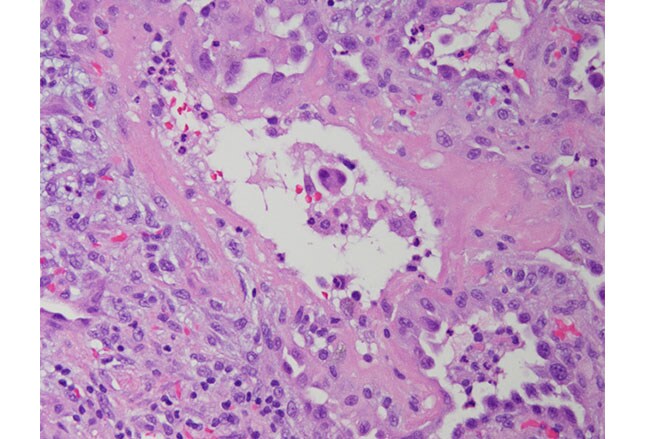 Acute Respiratory Distress Syndrome: A Complex Clinical Condition