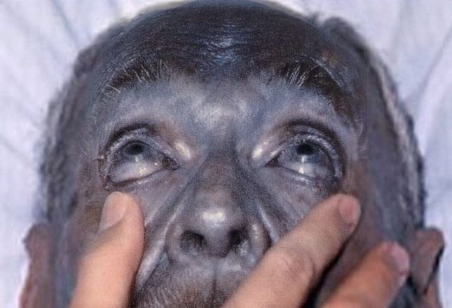 Poisoning Clues on the Skin: 10 Cases