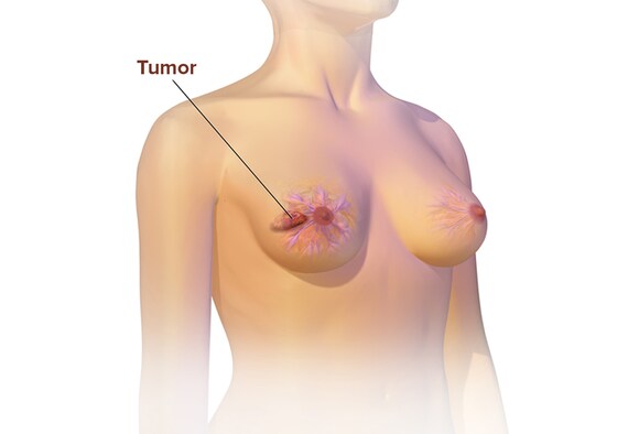 Advanced Breast Cancer The Later Stages