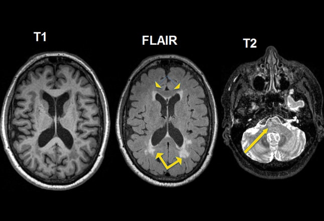 Alzheimer Disease: Diagnostic Challenges