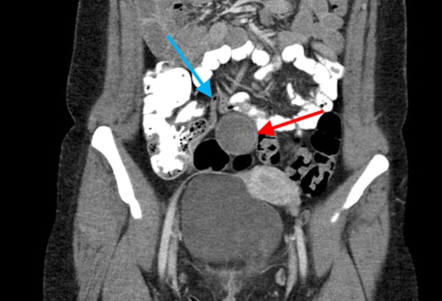 14 Mimics of Appendicitis