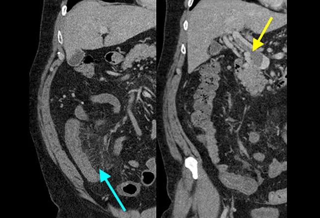 14 Mimics of Appendicitis