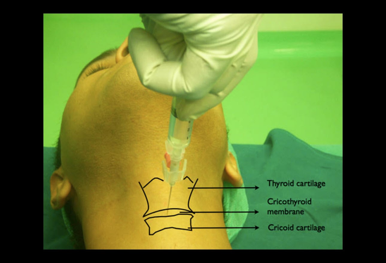 Awake Fiberoptic Intubation Accessing The Airway