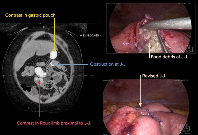 Complications After Bariatric Surgery A Weighty Concern