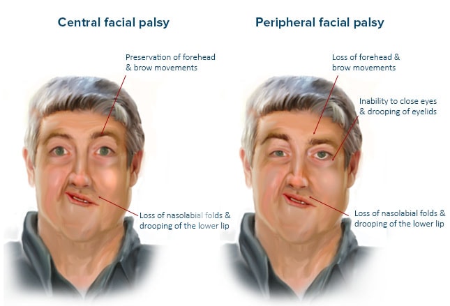 Right Facial Palsy 9
