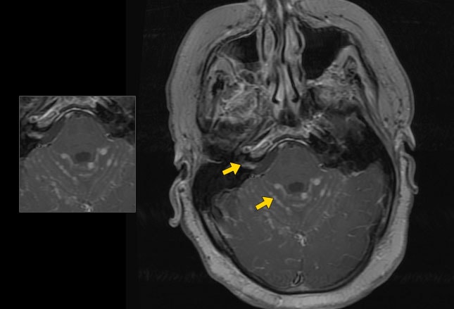  Bell Palsy A Clinical Diagnosis with a Management Challenge