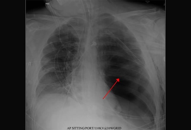 Sharp Force Trauma Radiograph Hard Hits: Blunt Force Trauma , Chest injuries – LNJE