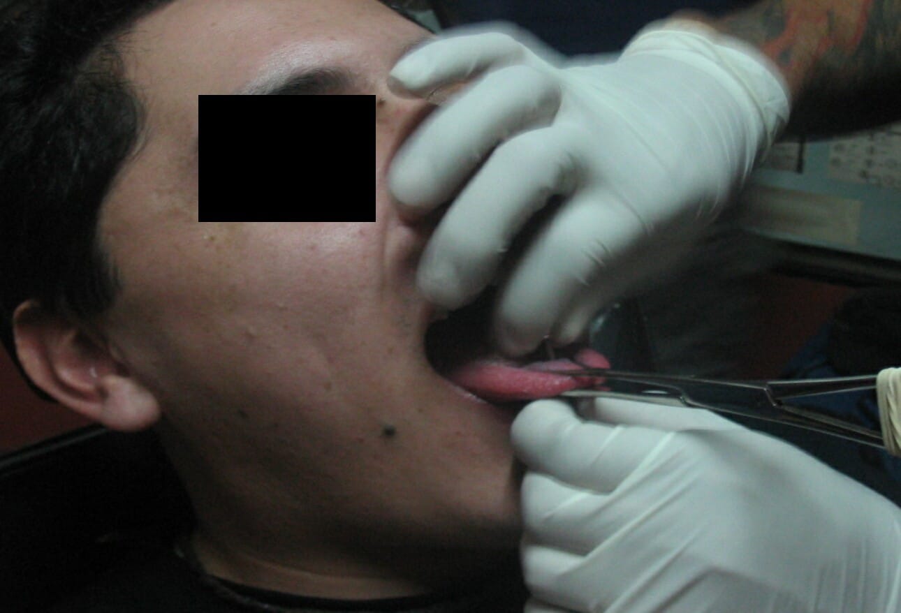 Body Modifications: Dermatologic Reactions and Risks