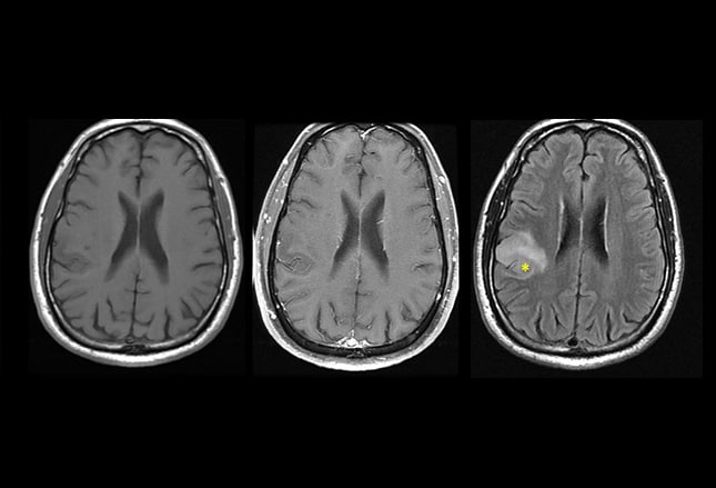 Brain Lesions: 10 Cases to Test Your Management Skills