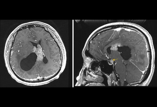 MS Brain Lesions and Their Effects