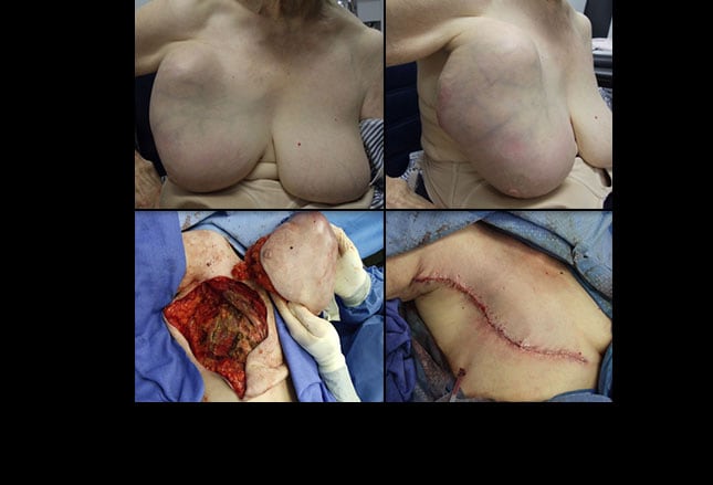 File:Breast reconstruction (4).jpg - Wikimedia Commons