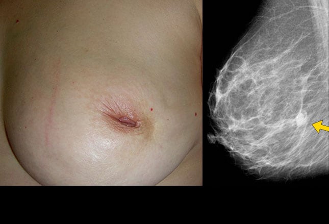 Breast Cancer: Surgical Approaches and Reconstruction