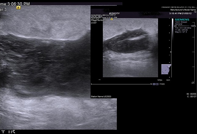 https://img.medscapestatic.com/pi/features/slideshow-slide/breastlumps/fig16.jpg