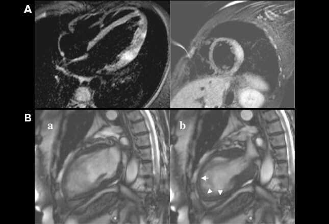 Keys To Diagnosing Broken Heart Syndrome (Takotsubo Cardiomyopathy)