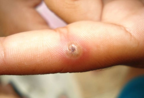 Image result for Bug Bites