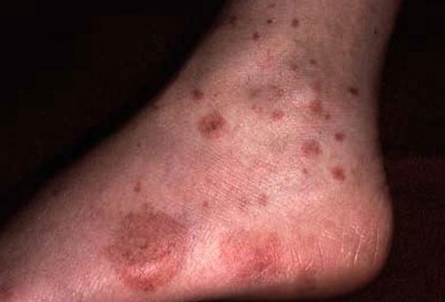 An Active-Duty Soldier With a Strange Rash: Case Presentation