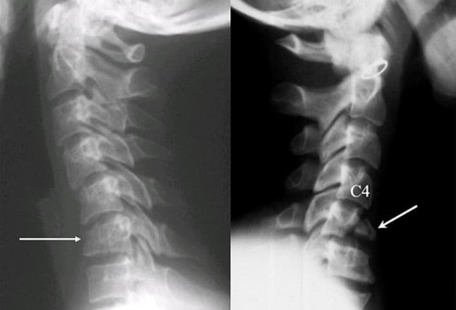 cervical spine x ray icd 10