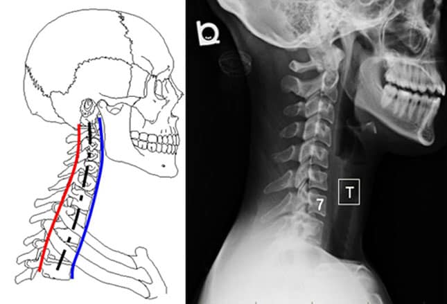 Interpretations Of The C Spine On Plain Radiography