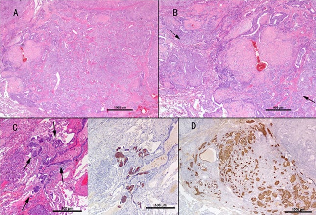 Carcinoid Tumors: Cancers in Slow Motion