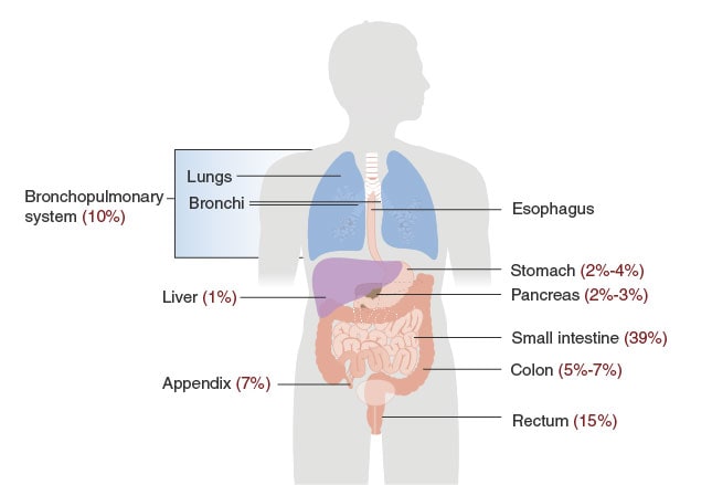 carcinoid-tumors-cancers-in-slow-motion