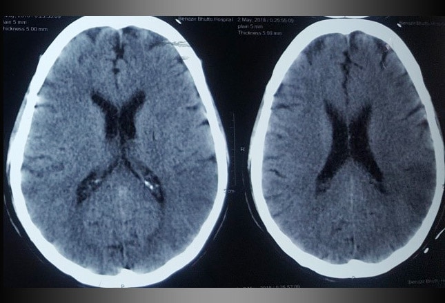 Cerebrovascular Accident: A Stroke of Misfortune