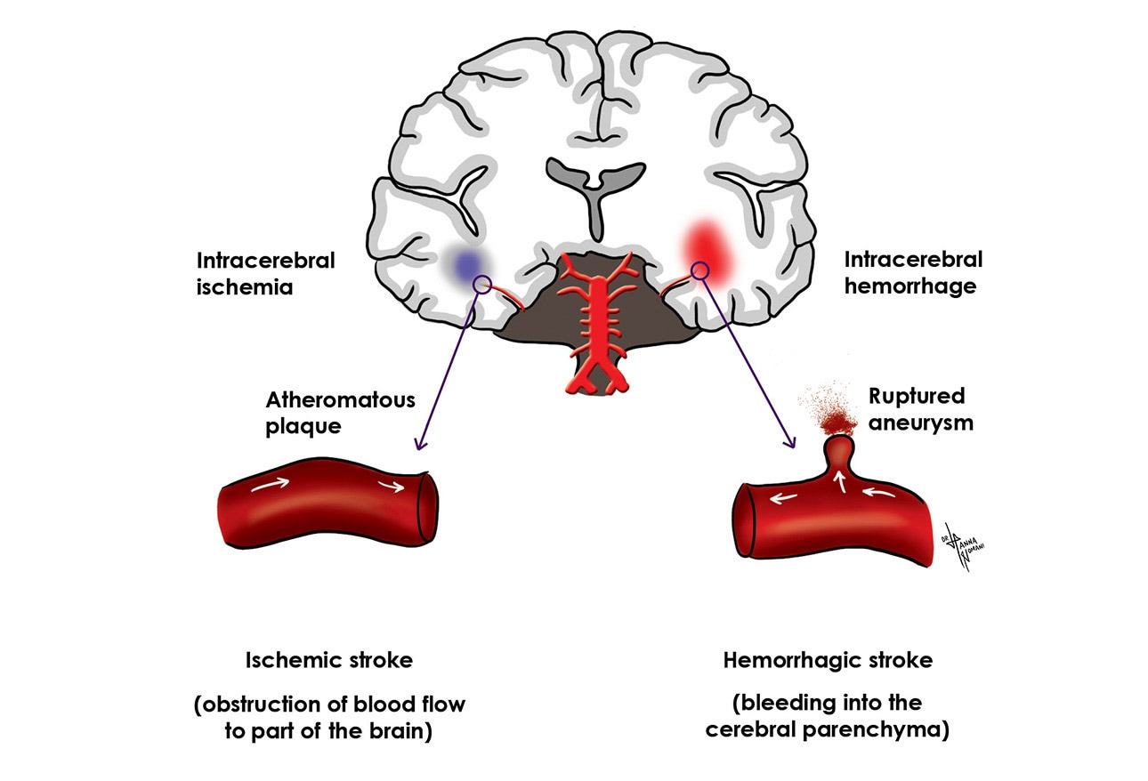 accident-vascular-cerebral-simptome-cauze-tratament-the-best-porn-website