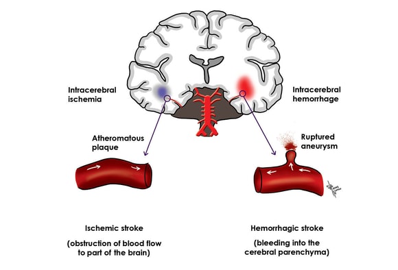 Subarachnoid hemorrhage - Wikipedia