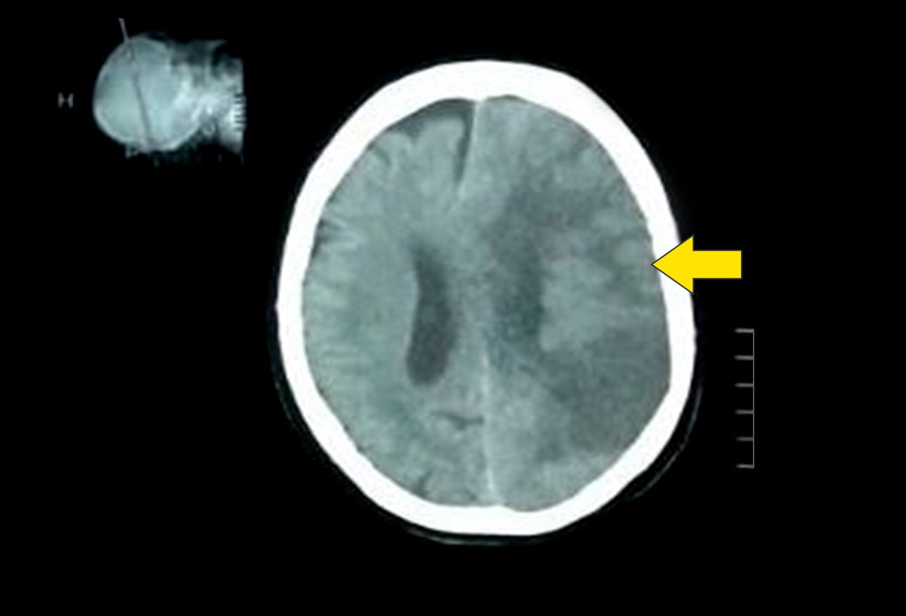 cerebrovascular-accident-cva-in-5-minutes-the-nurses-post