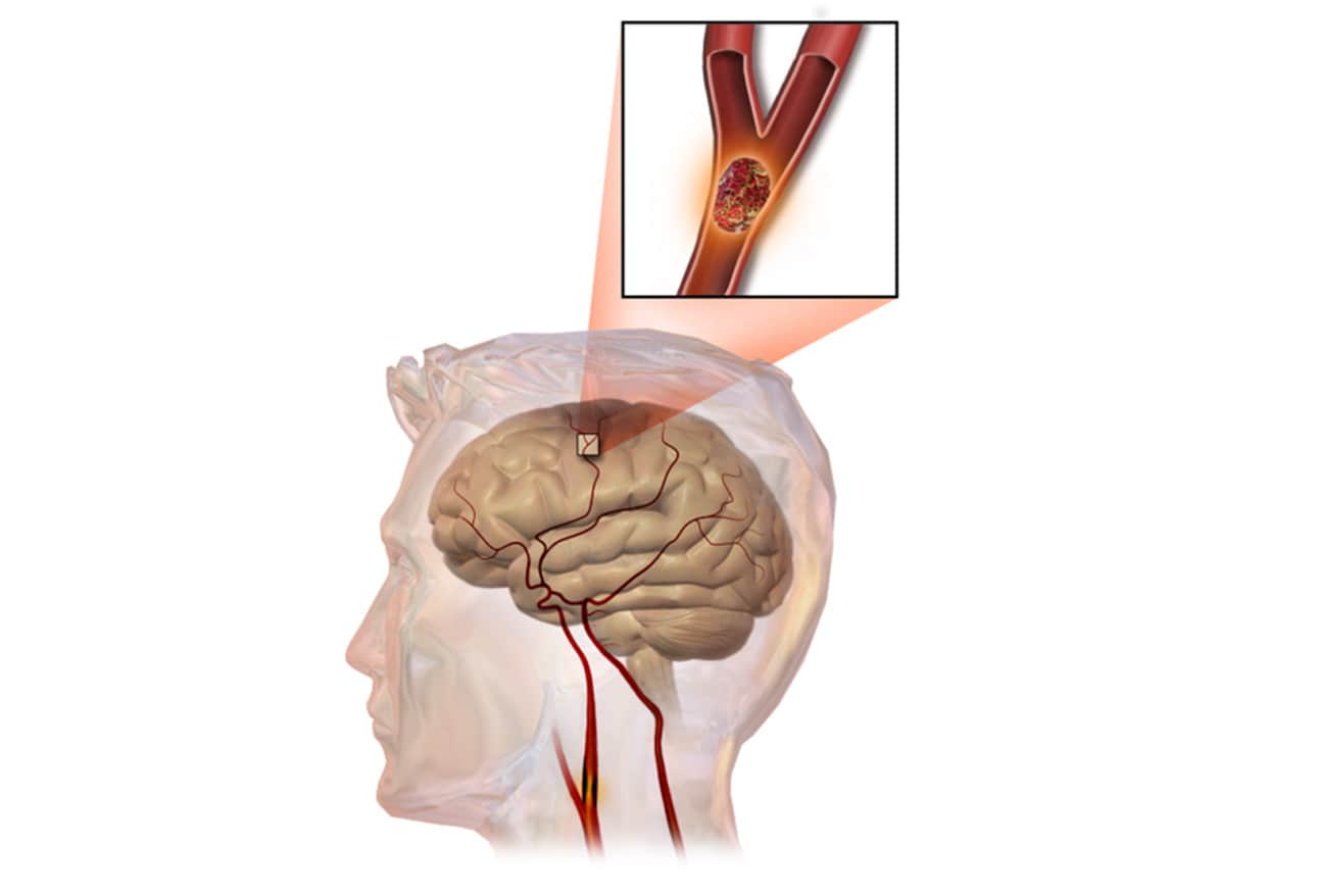 cerebrovascular-accident-a-stroke-of-misfortune