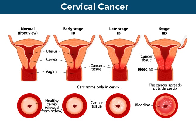 Cervical Cancer: Screening, Recognition, and Treatment