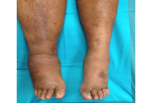 Diabetes Leg Rash