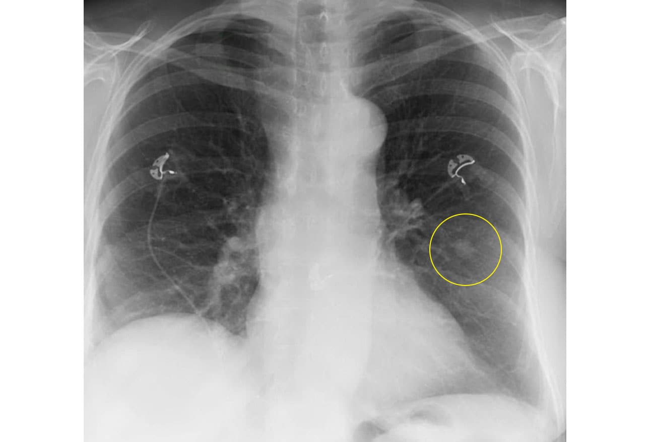 Small And Narrow Chest, Spot Diagnosis