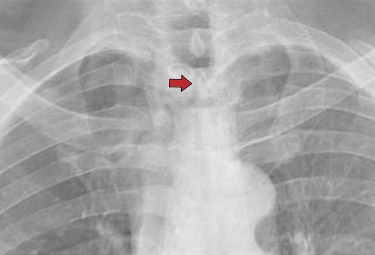 Chest XRays 16 Subtle But Key Findings You Need to Know