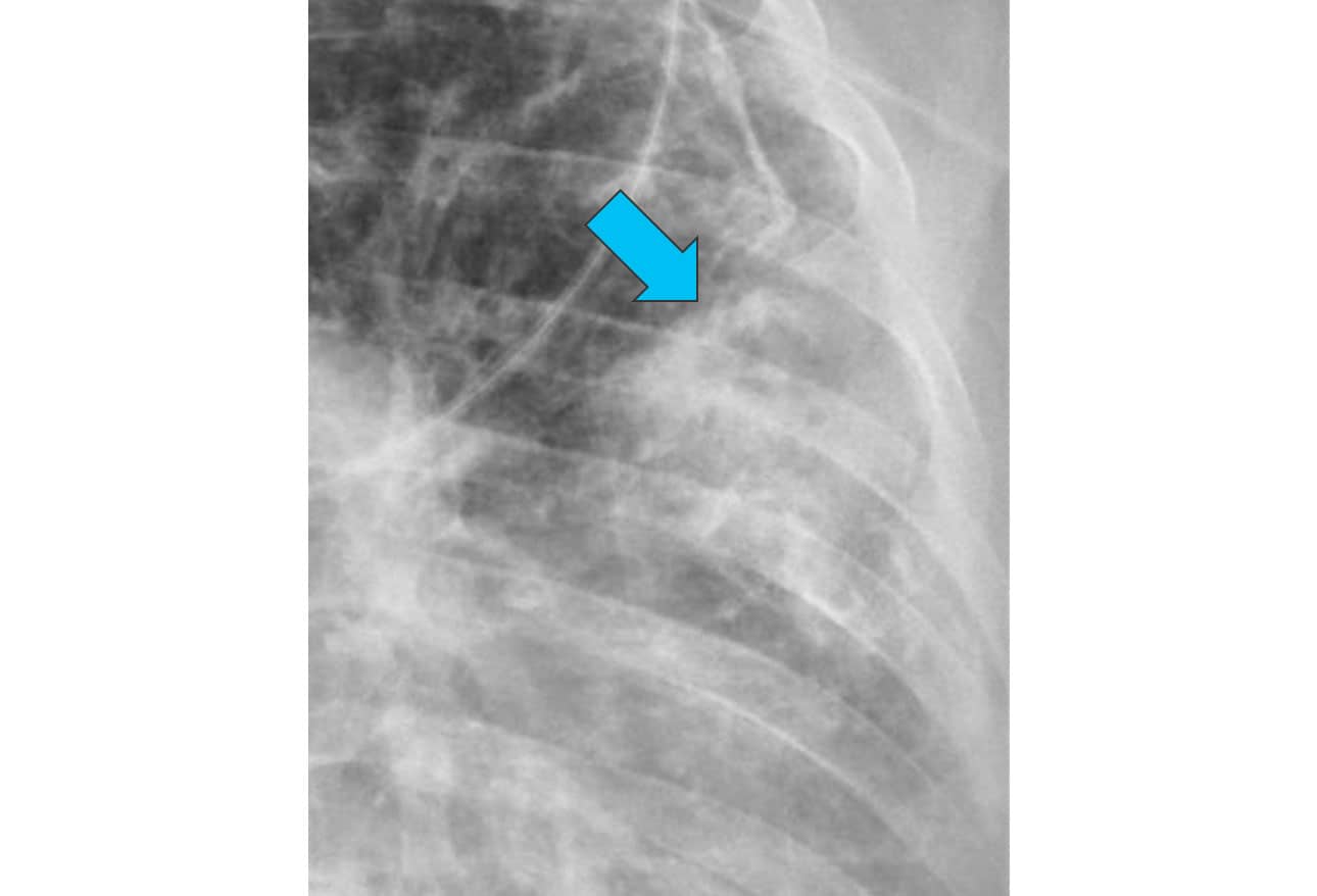 Chest XRays 16 Subtle But Key Findings You Need to Know
