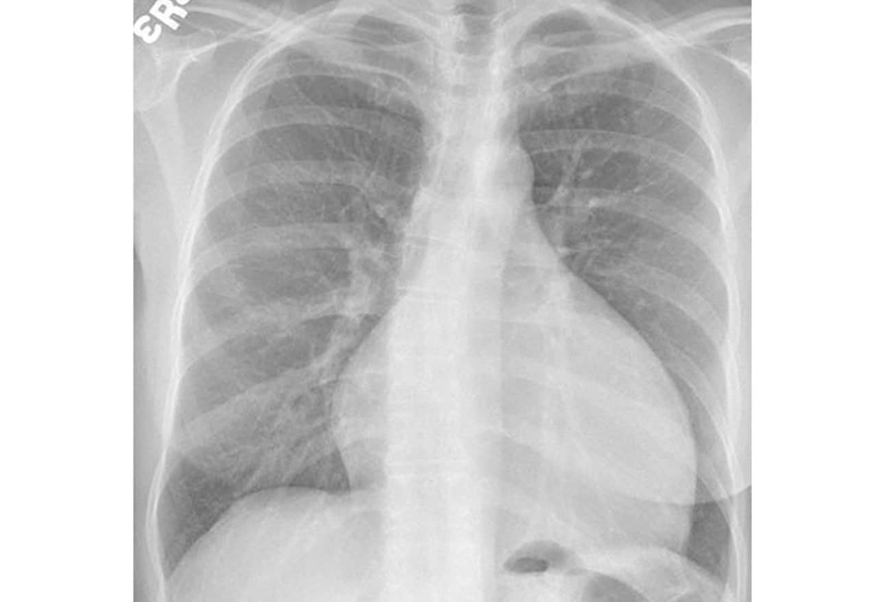 Chest XRays 16 Subtle But Key Findings You Need to Know