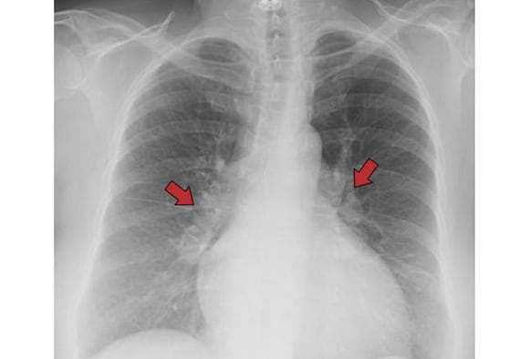 Chest X Rays 16 Subtle But Key Findings You Need To Know