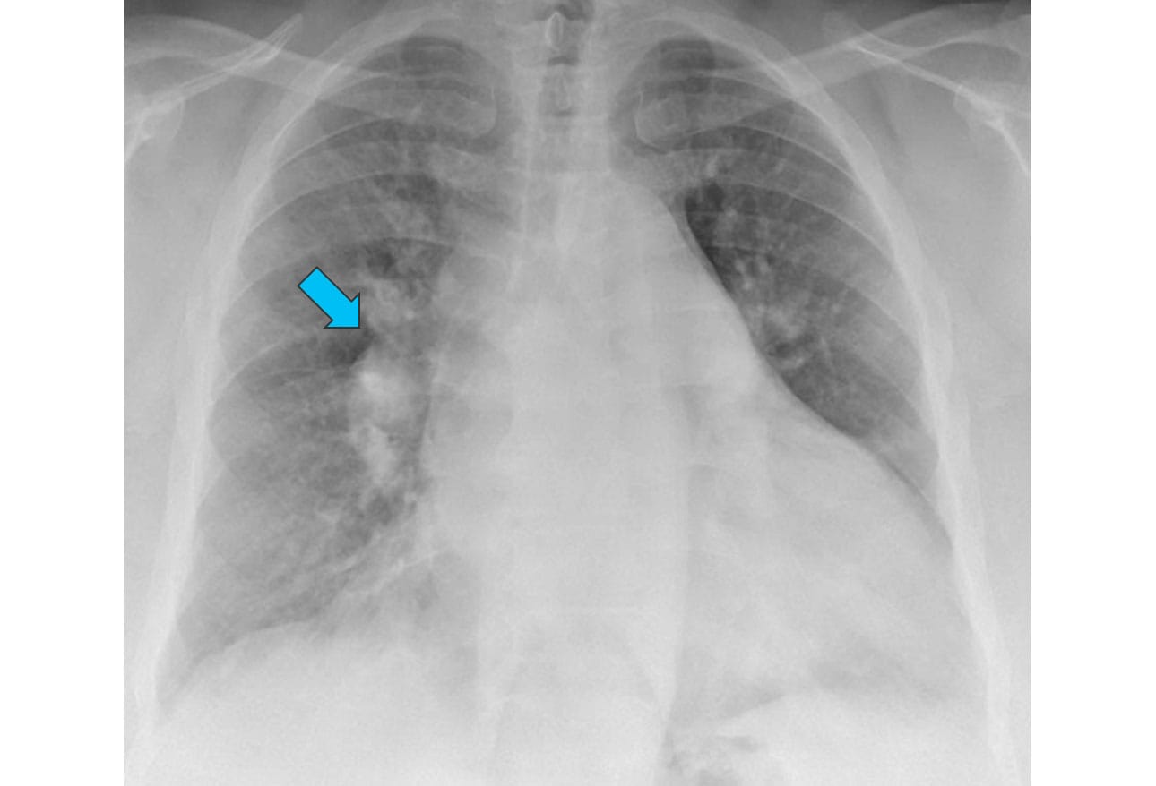 Chest X-Rays: 16 Subtle But Key Findings You Need to Know