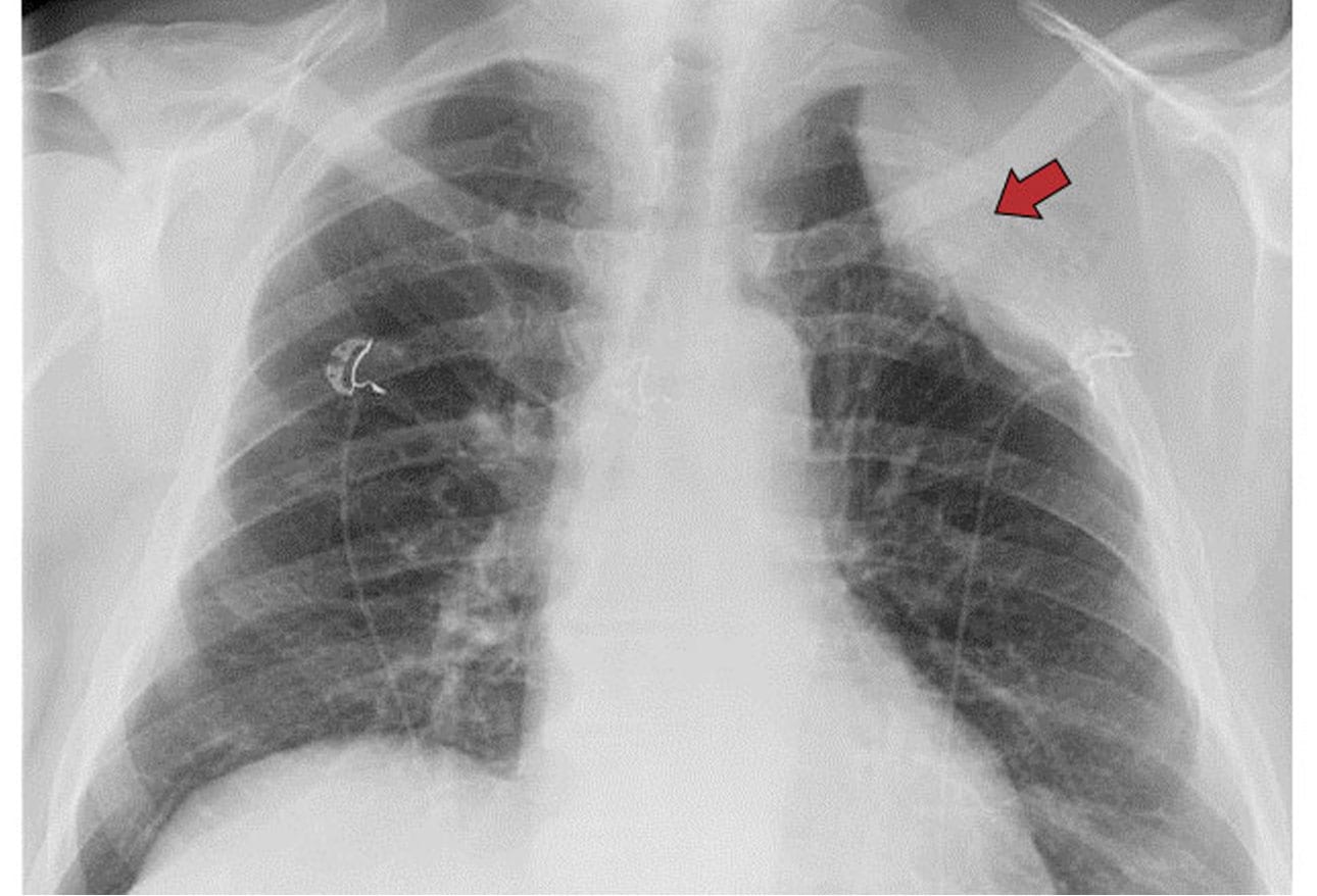 Chest XRays 16 Subtle But Key Findings You Need to Know