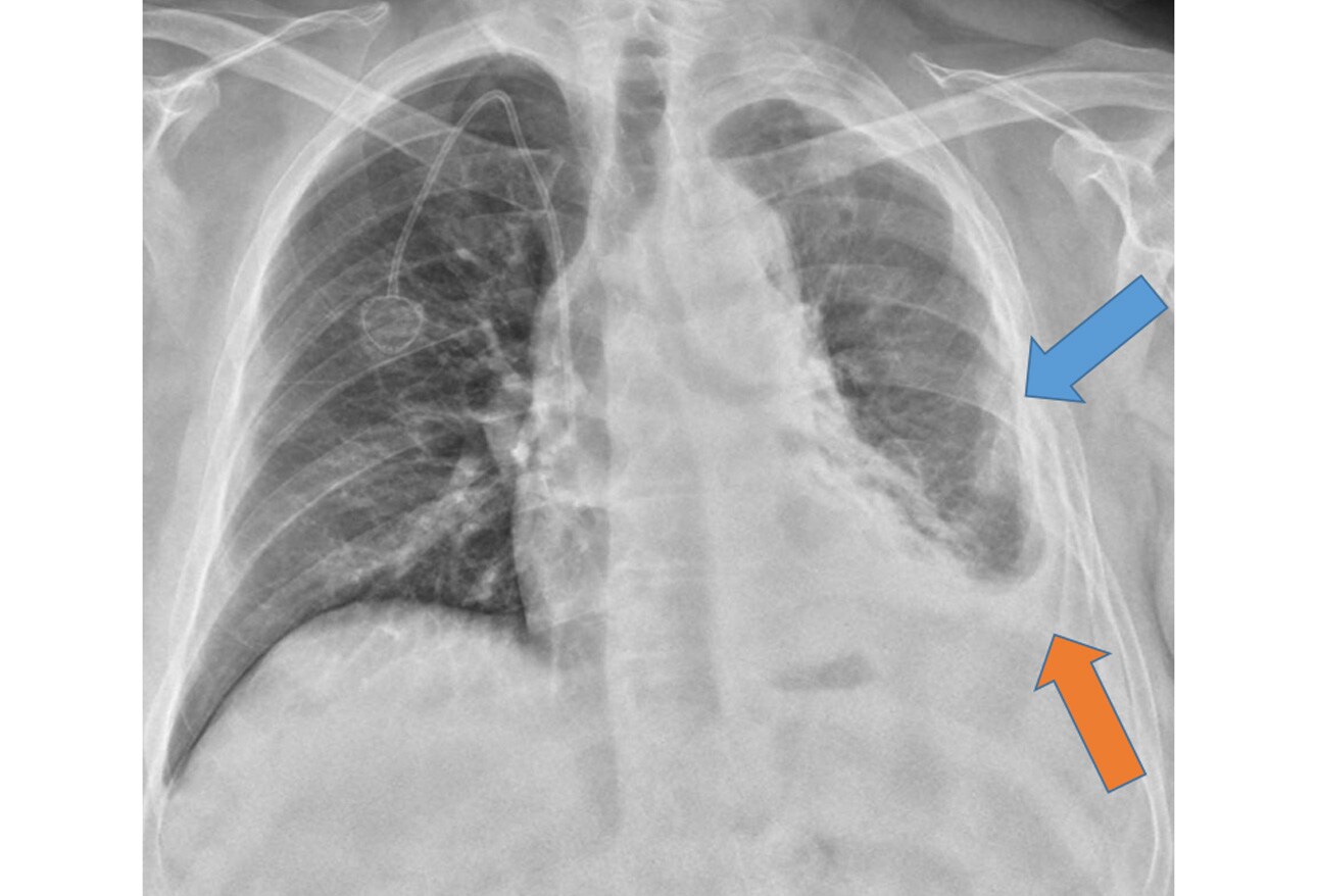 Chest XRays 16 Subtle But Key Findings You Need to Know
