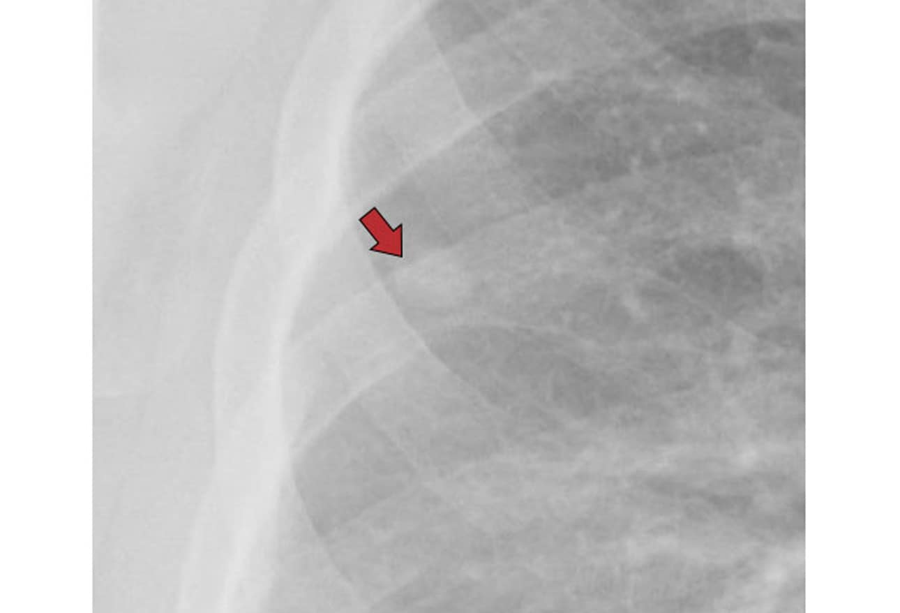 Chest XRays 16 Subtle But Key Findings You Need to Know