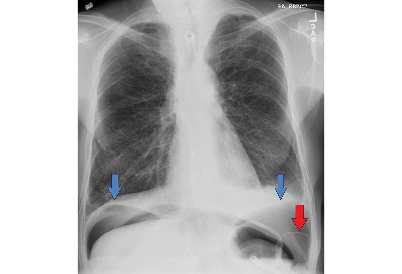 Critical Chest Radiographs: Can't-Miss Diagnoses