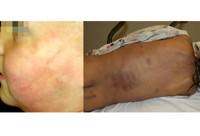 Recognizing Physical Child Abuse Recognizing Physical Child Abuse