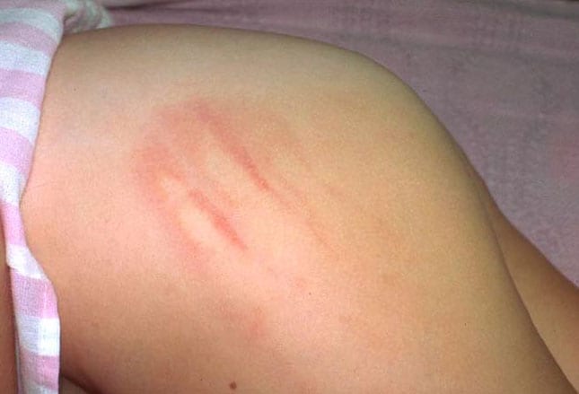 Recognizing Physical Child Abuse Recognizing Physical Child Abuse