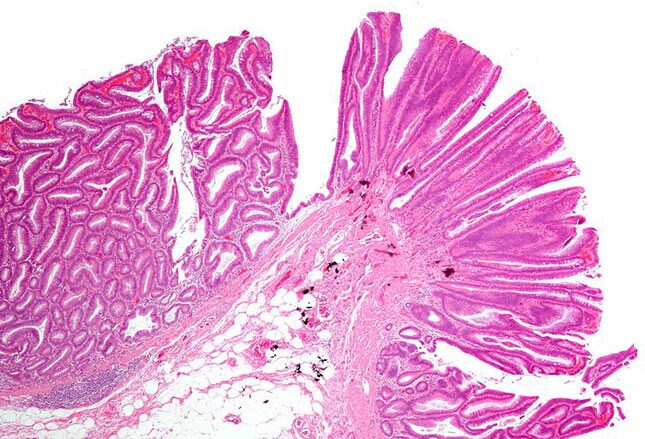 Benign or Malignant: Can You Identify These Colonic Lesions?